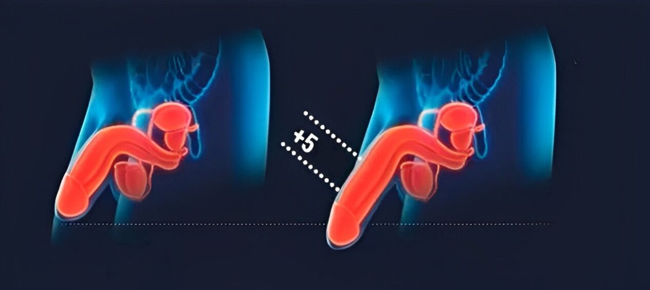 penis enlargement with hyaluronic acid