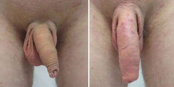 Penis before and after hanging weights